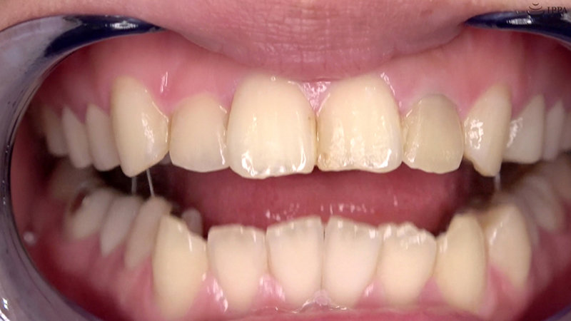 ad-692 sample