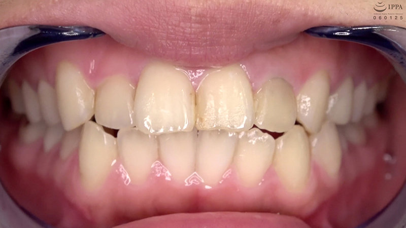 ad-692 sample