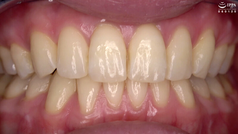 ad-1411 sample