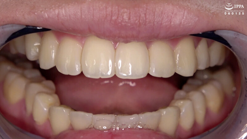 ad-1525 sample