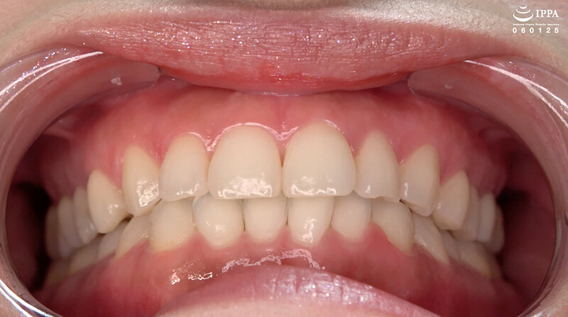 ad-1708 sample